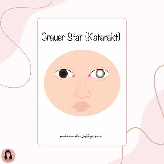 Digitaler Lernzettel - Grauer Star (Katarakt)