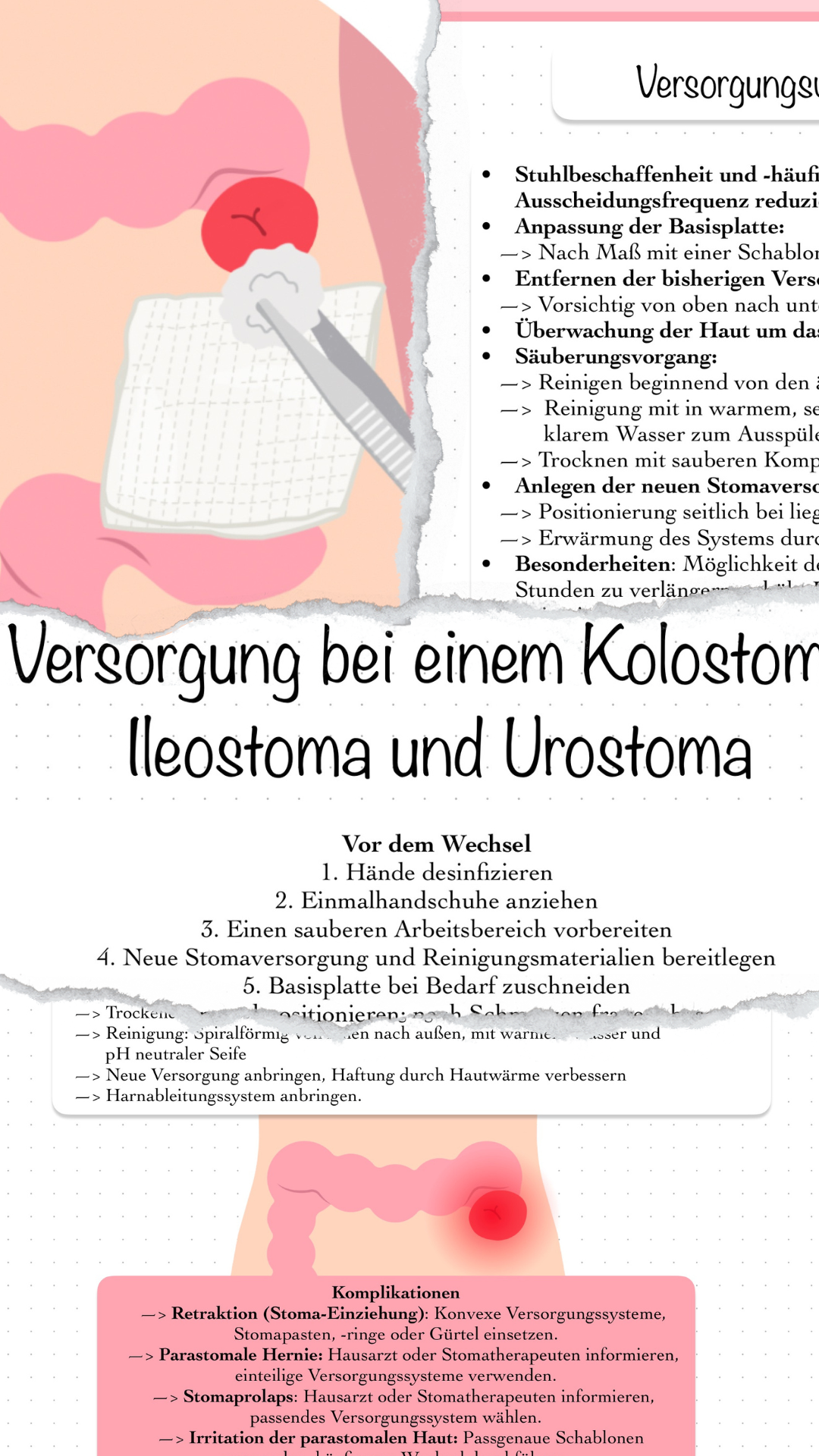 Digitaler Lernzettel - Versorgung bei einem Kolostoma, Ileostoma und Urostoma