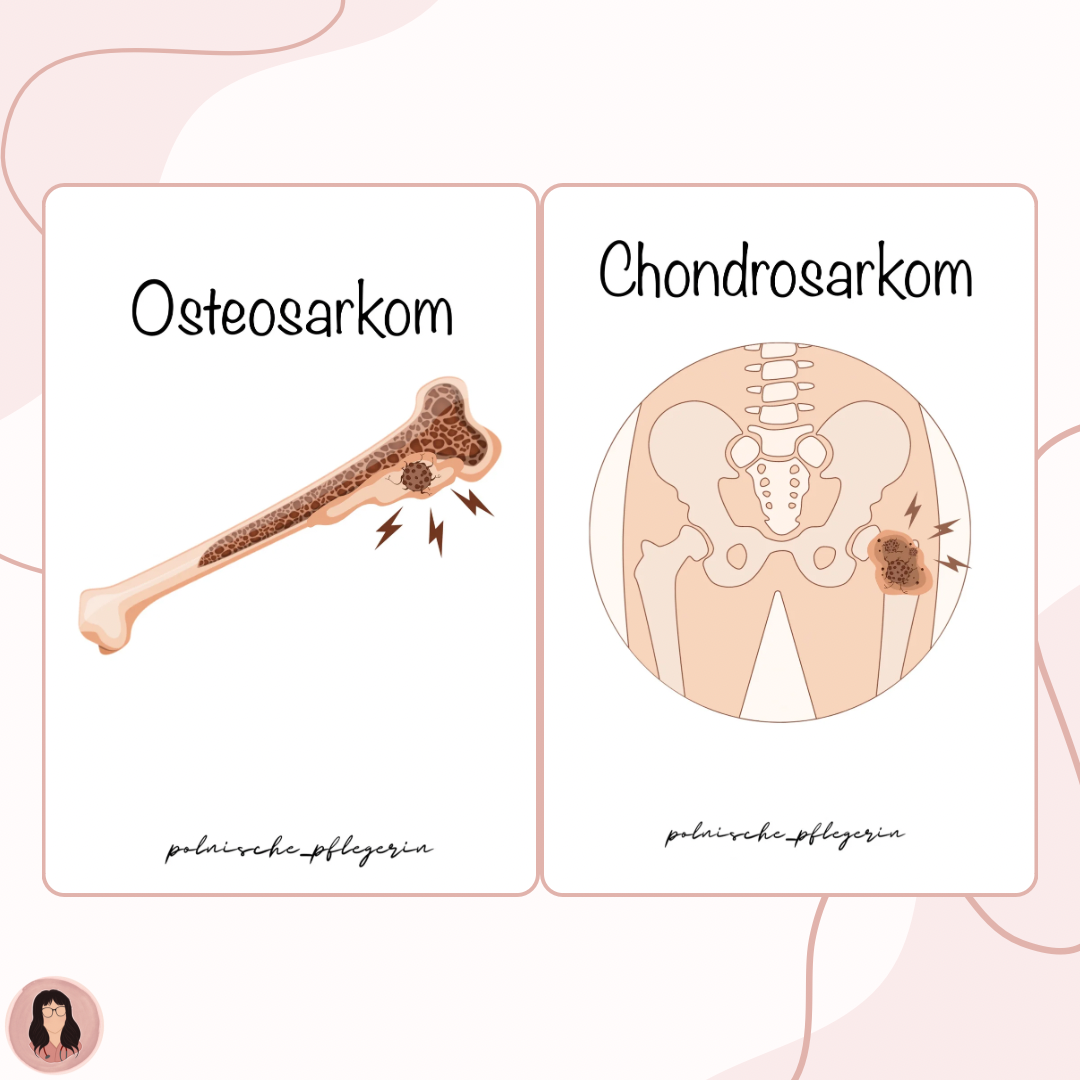 Digitaler Lernzettel - Chondrosarkom und Osteosarkom (Knochentumor)