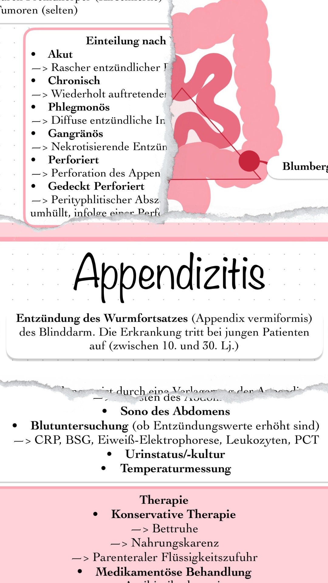 Digitaler Lernzettel - Appendizitis