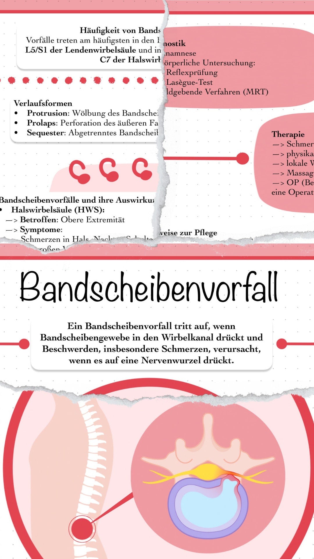 Digitaler Lernzettel - Bandscheibenvorfall